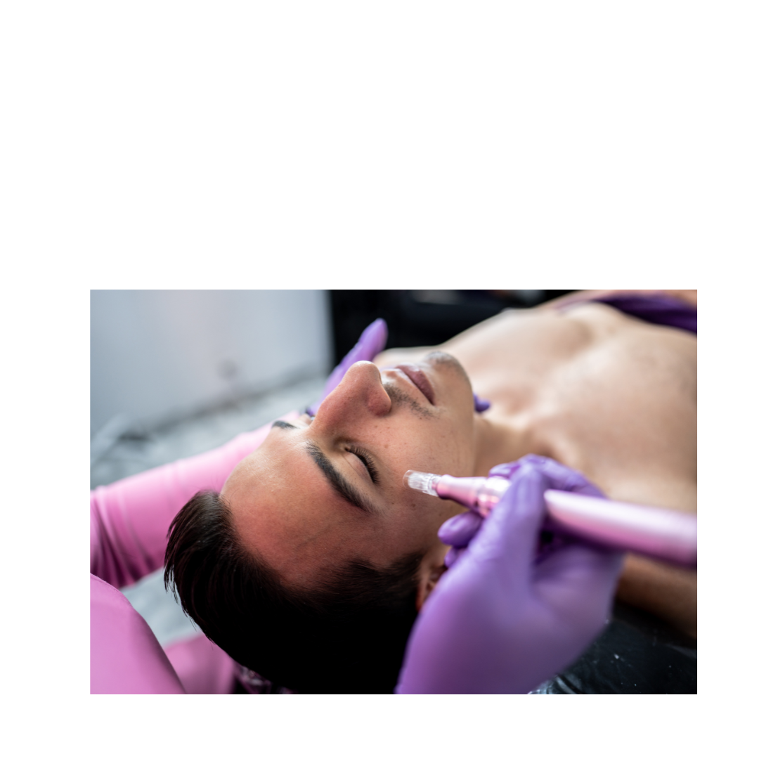 Microneedling Behandlung